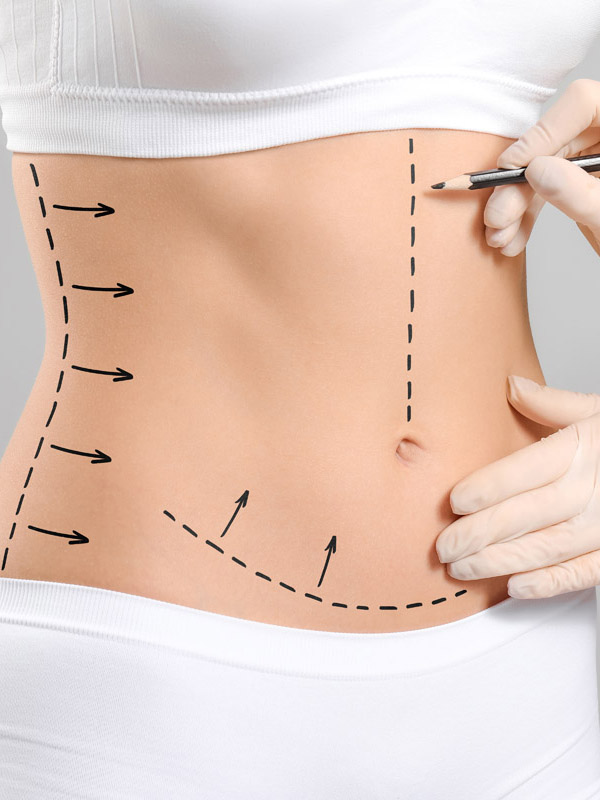 Реабилитация после абдоминопластики